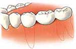 Het vastzetten van een kroon bij tandarts: tandzorg Kralingen