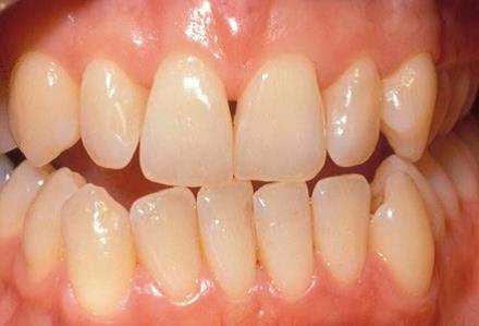 Status gebit voor het bleken van de tanden bij Tandzorg Kralingen