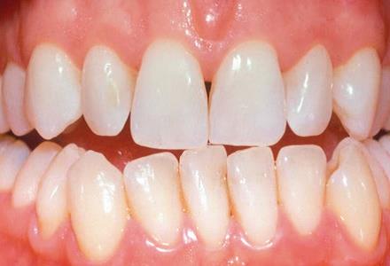 Status gebit na het bleken van de tanden bij Tandzorg Kralingen